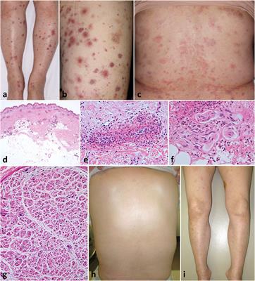 A case of refractory peripheral neuropathy associated with eosinophilic granulomatosis with polyangiitis with successful tapering of systemic corticosteroid and reduced dosing frequency of high-dose intravenous immunoglobulin after combined use of mepolizumab